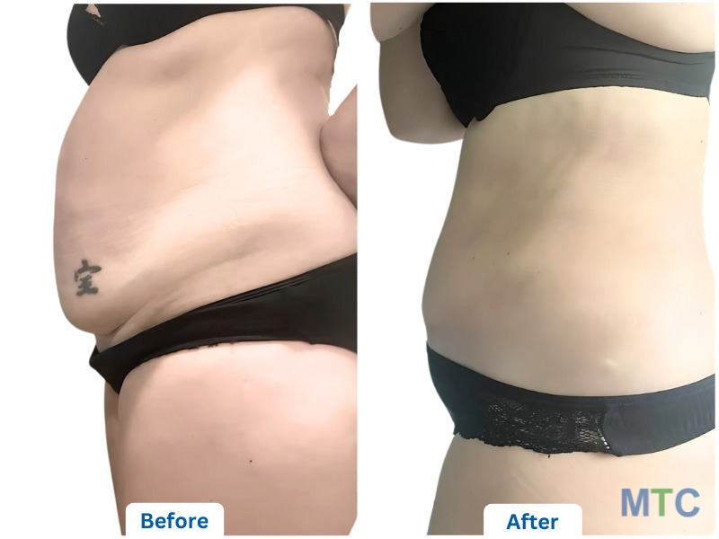 Before and after image of tummy tuck surgery in KCM Clinic, Poland