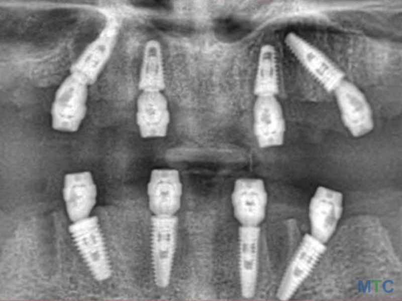 X rays After Implant placement