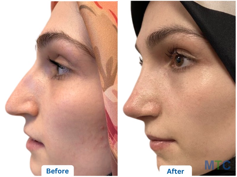 Rhinoplasty in Turkey- Before and After Results