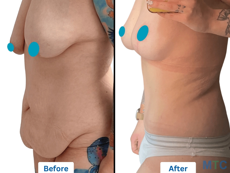 a before and after of a 360 tummy tuck combined with a breast reduction surgery