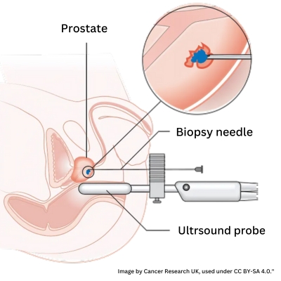 Biopsy Test