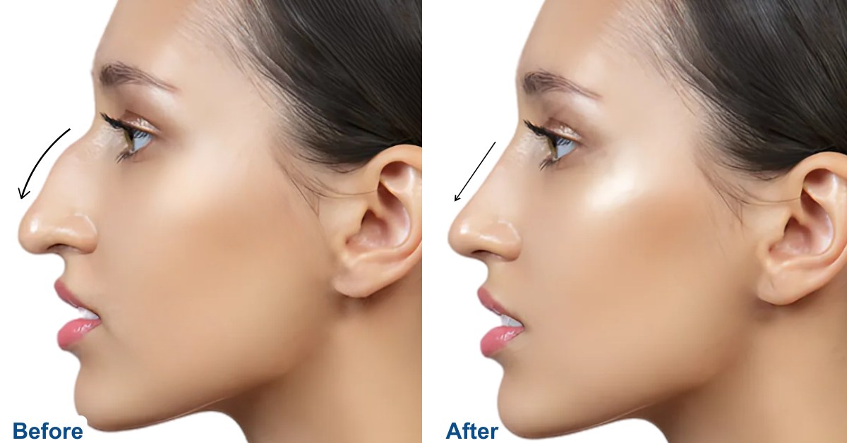 Ethnic Rhinoplasty in Turkey