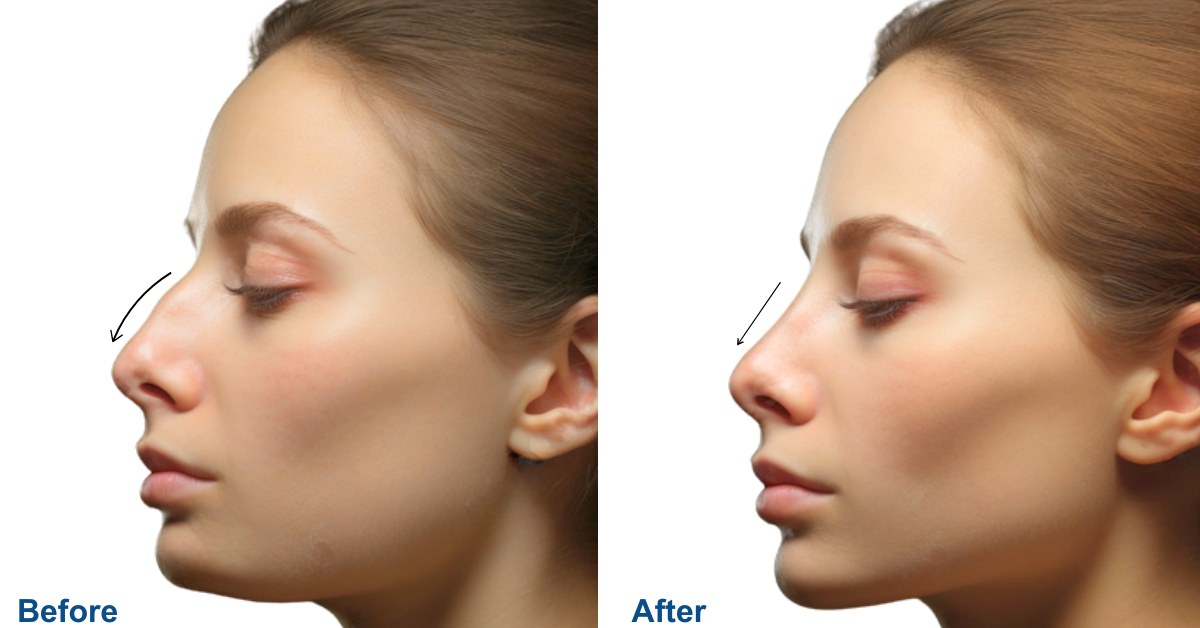 Ethnic Rhinoplasty in Vietnam