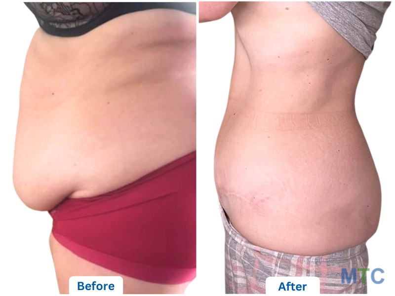 Before and after image of liposuction surgery in KCM Clinic, Poland