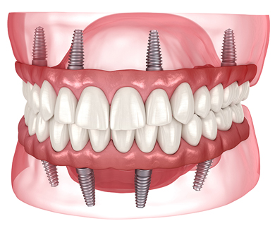 All-on-4 dental implants