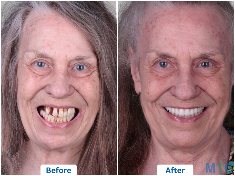 Dental Implants