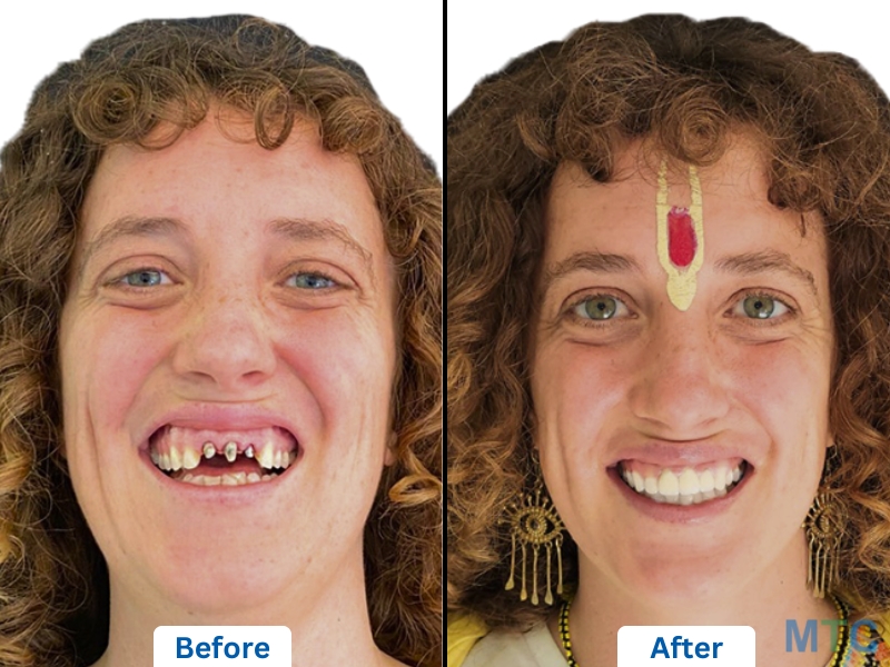 Satisfied Patient After Getting Dental Bridge in Delhi