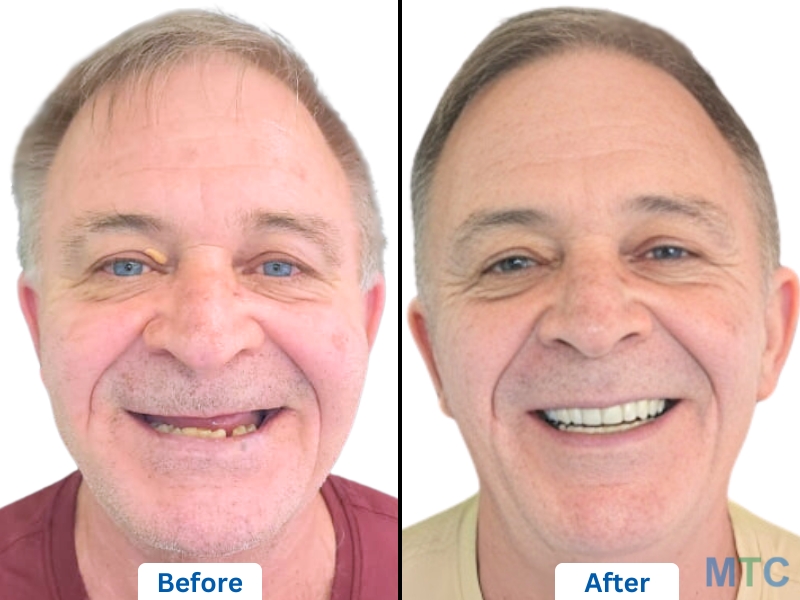 Happy Patient With Upper Jaw Implants via Dental Tourism in Delhi