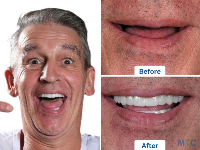 All on 4 Dental Implants