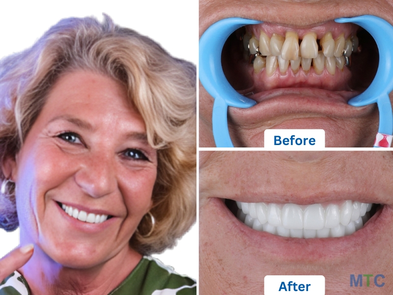 All on 4 Dental Implants