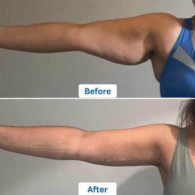 Before and after images of a surgery that removes loose skin from the arm