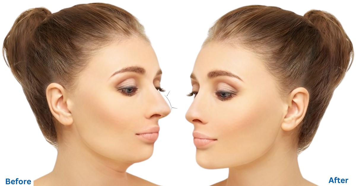 Rhinoplasty in Turkey