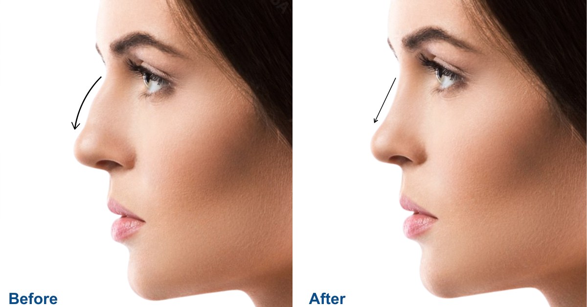 Rhinoplasty in Antalya