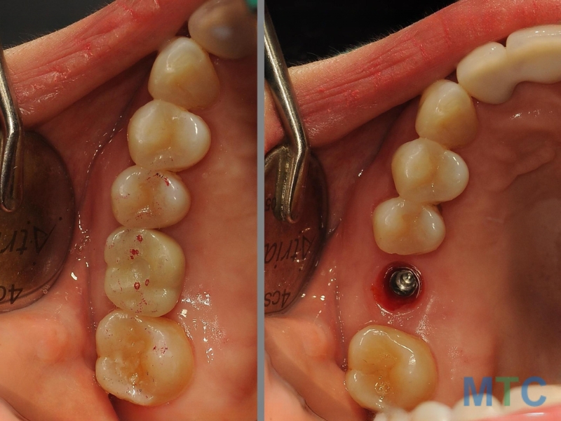 Before and After Implant Placement