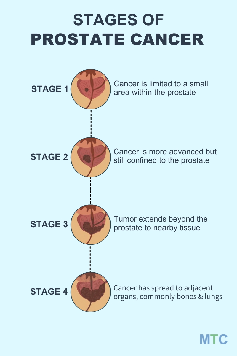 Stages of Prostate Cancer