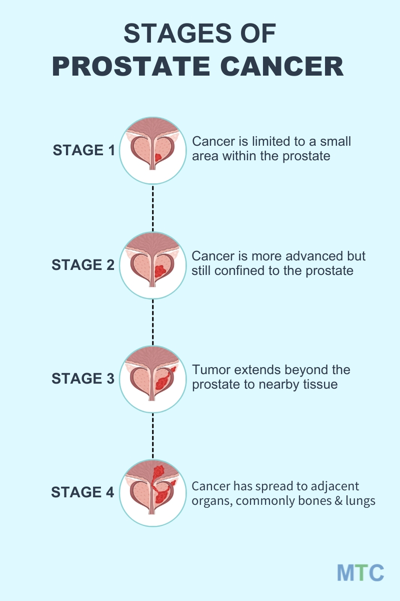 Prostate Cancer Stages