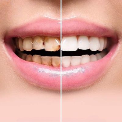 Teeth Whitening