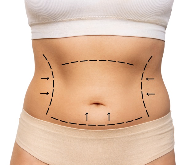 tummy tuck