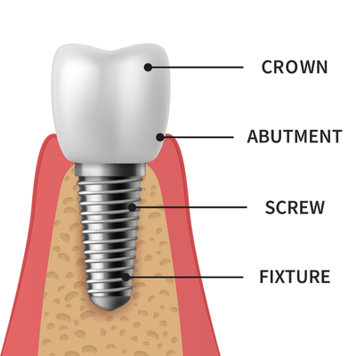 Dental Implants