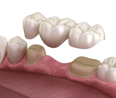 Zirconium crown