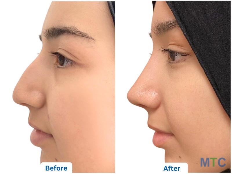 Rhinoplasty- Before and After