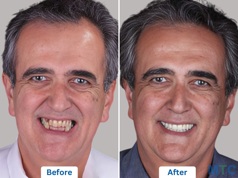 Dental Implants