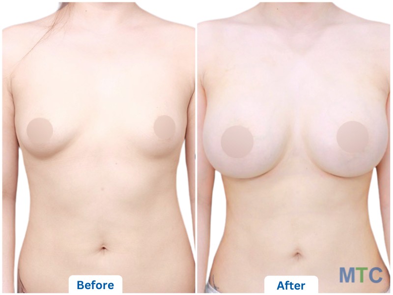 Before and After_Breast Augmentation