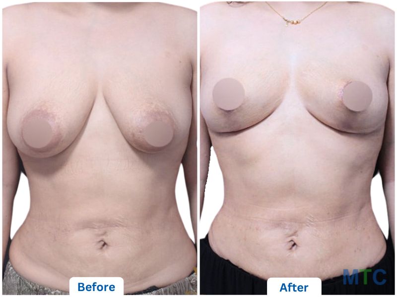 Before & After_Breast Reduction+Breast Lift