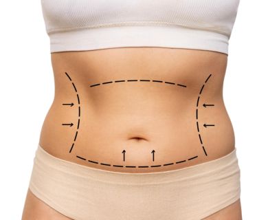 Tummy tuck