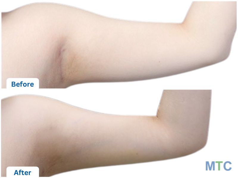 Before and After_Liposuction-Arm