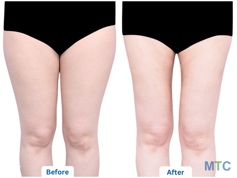 Before and After_Thigh Liposuction