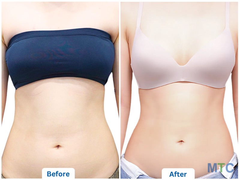 Before and After_Liposuction-Abdomen