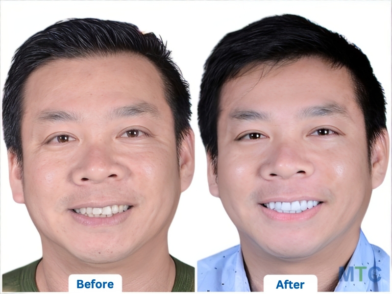 Before and after pictures of stained teeth treatment with veneers