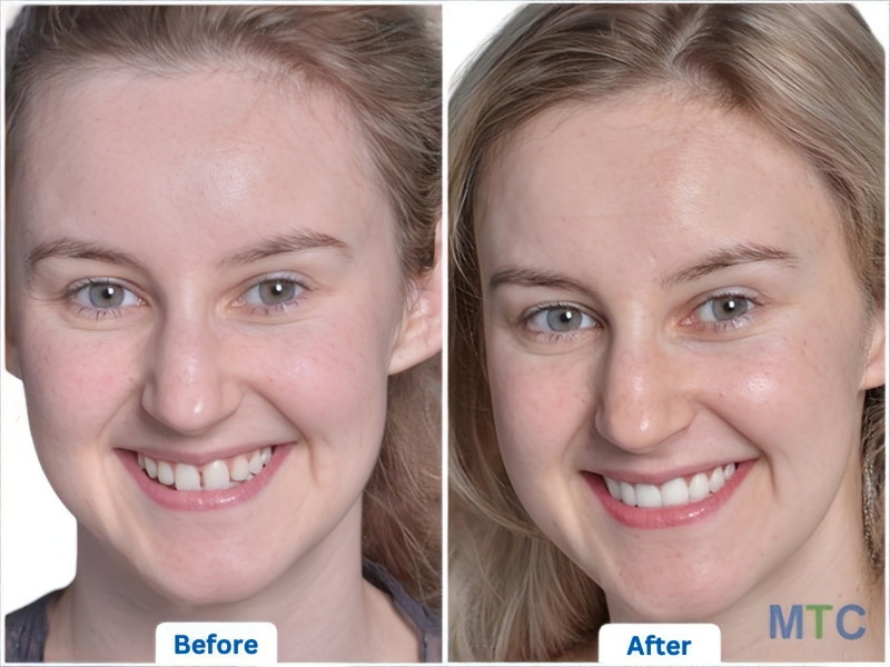 A patient whose tooth gap got fixed with veneers