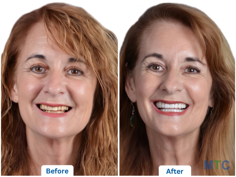 A patient's before and after picture of getting discolored teeth fixed with veneers