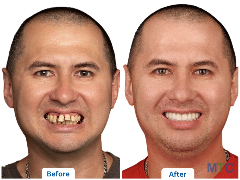 Dental Implants