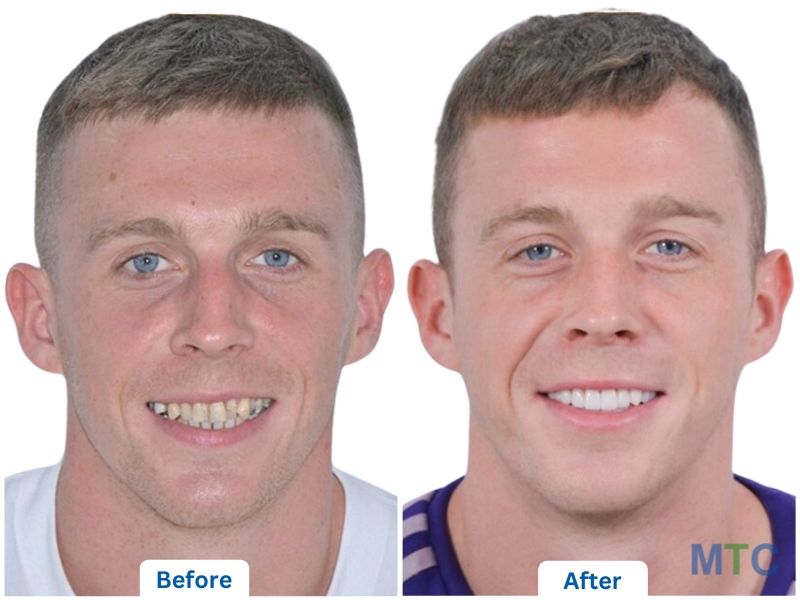 A patient who got a smile makeover with veneers