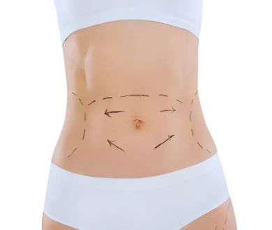 liposuction: mini tummy tuck