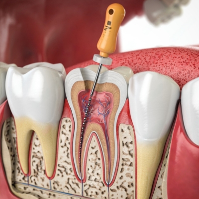 Root Canal Treatment