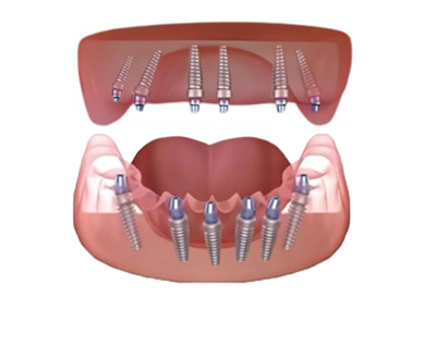 all on 6 dental implants