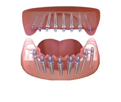 all on 8 dental implants