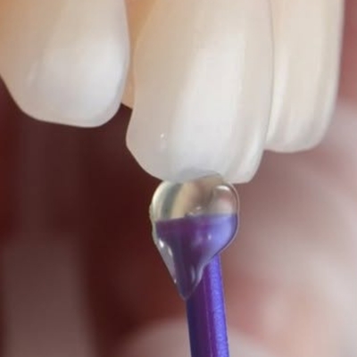 Ceramic veneers being applied to a patient's teeth