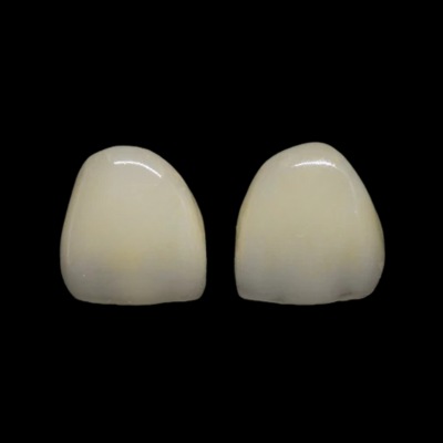 A sample of composite veneers