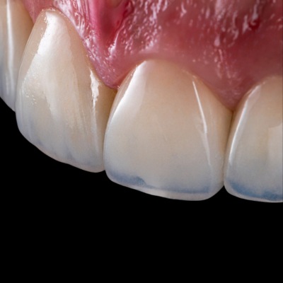 Emax laminates applied to a patient's teeth