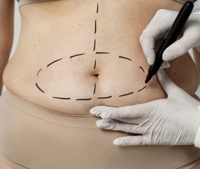 markings in the stomach for a surgery