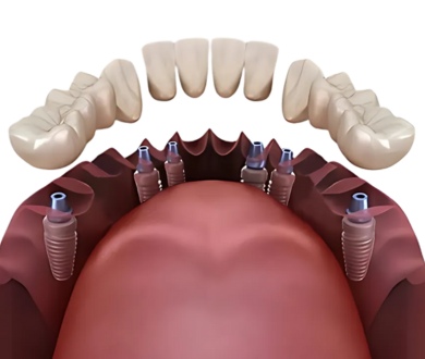 3 on 6 dental implants Package