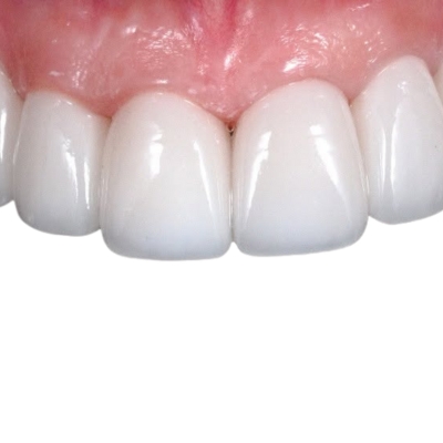 Porcelain veneers applied to someone's teeth 