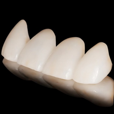 A sample of zirconium veneers displayed 