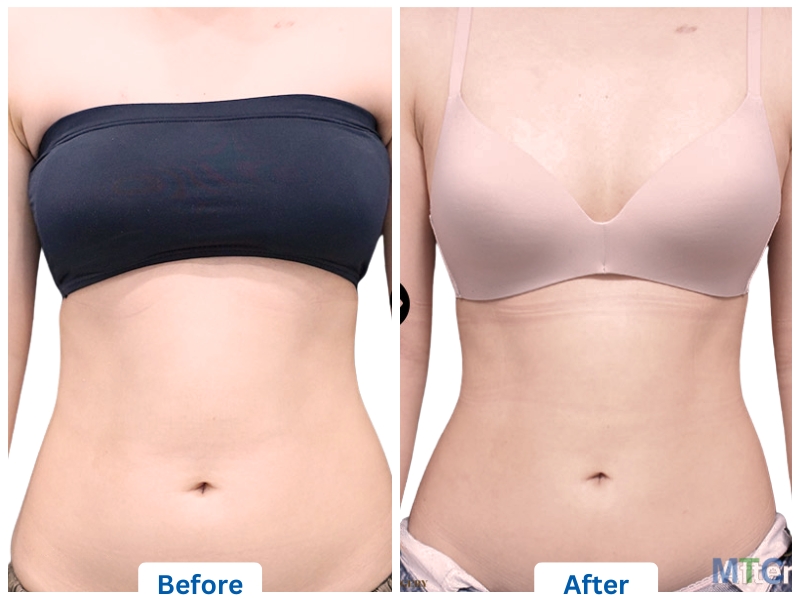 Before and after image of tummy tuck procedure