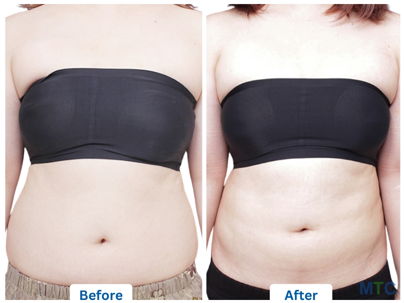 Before and after image of tummy tuck procedure